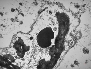 M, | dystrophic calcification and malaric pigment - brain